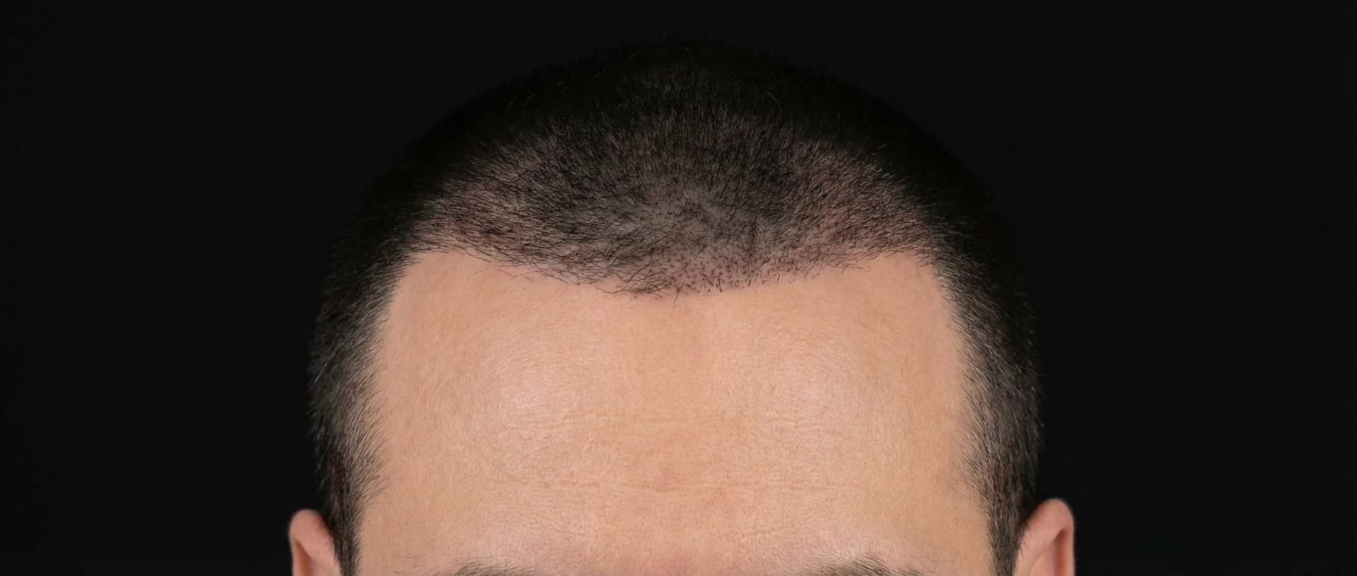 Mature Recessed diagram