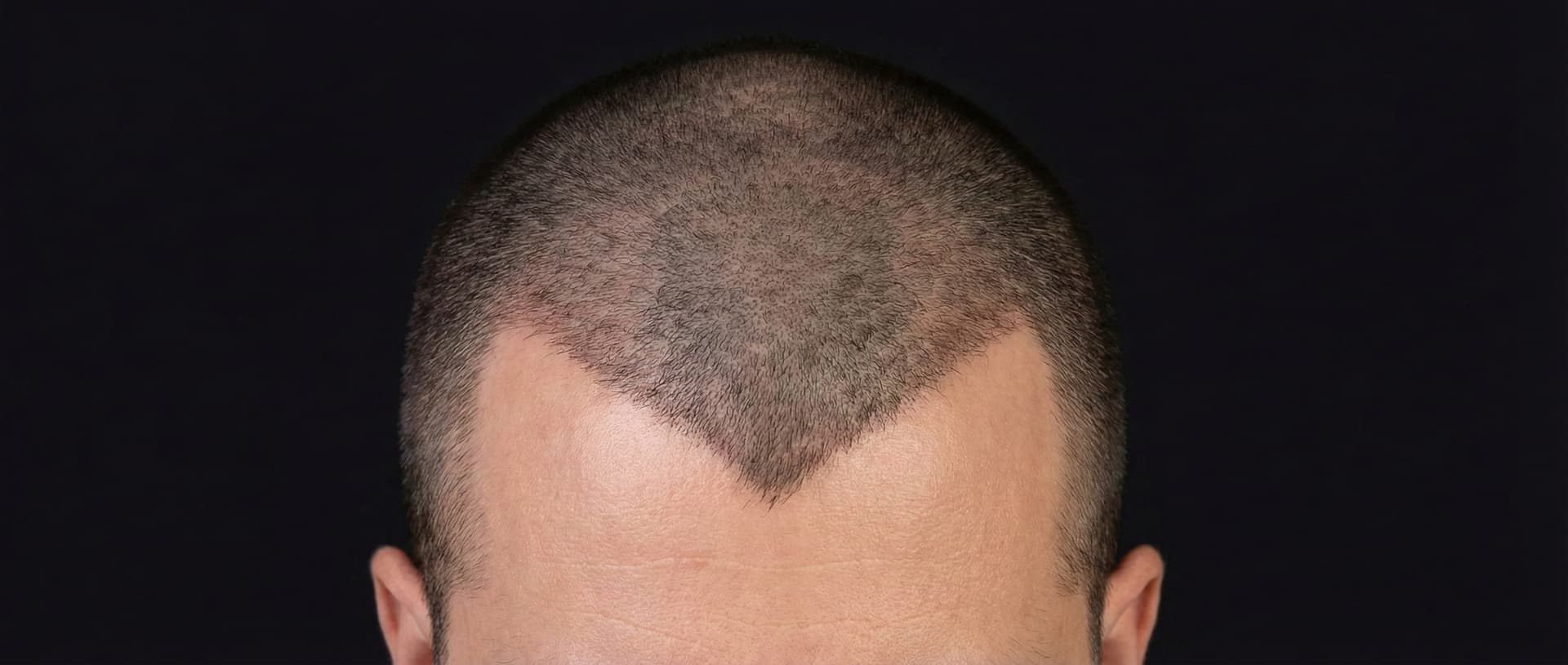 Widow's Peak diagram